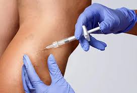Sclerotherapy